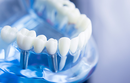 Wohlfühlpraxis Friedberg Implantologie